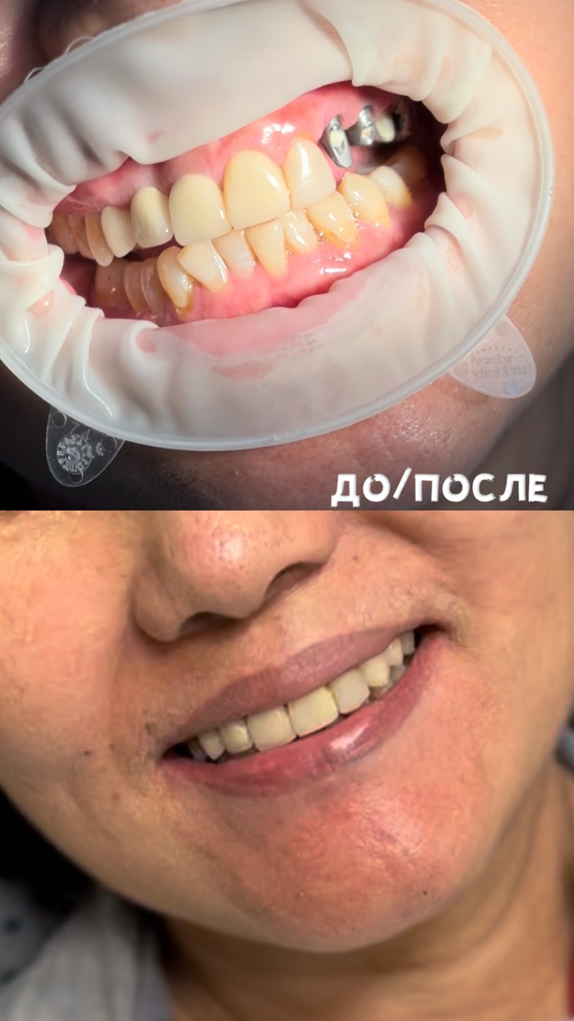 Герметизация фиссур