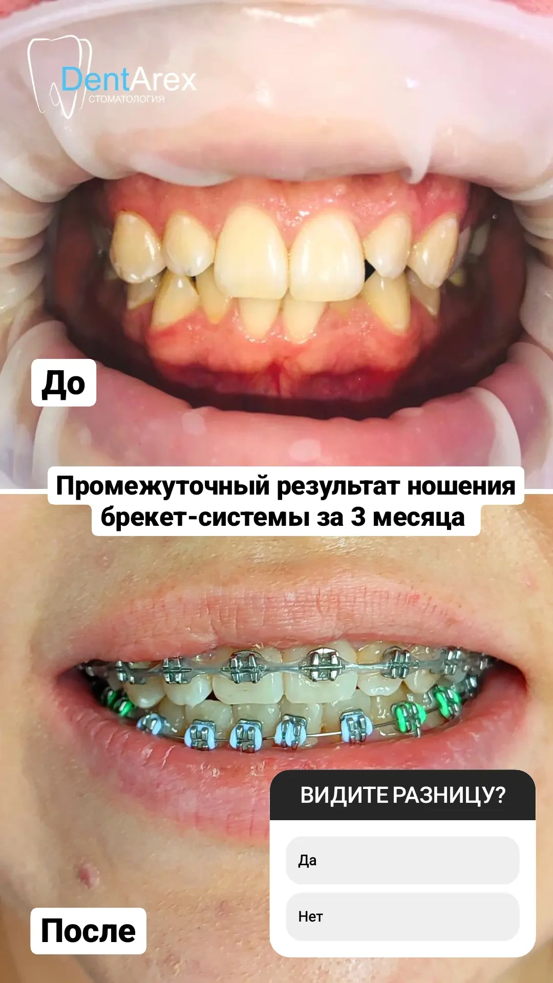 Металлокерамические коронки