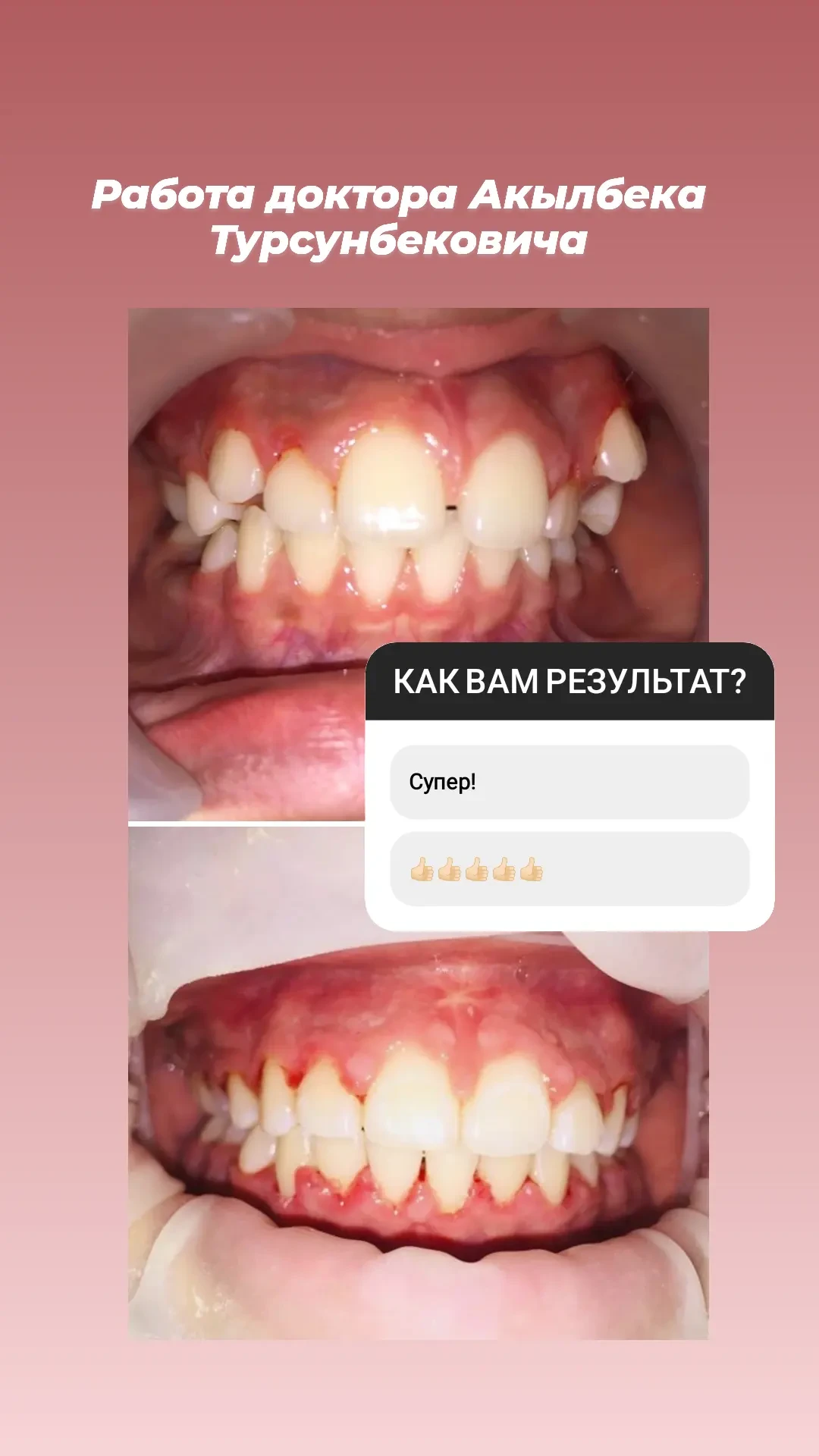 Лечение кариеса и реставрация