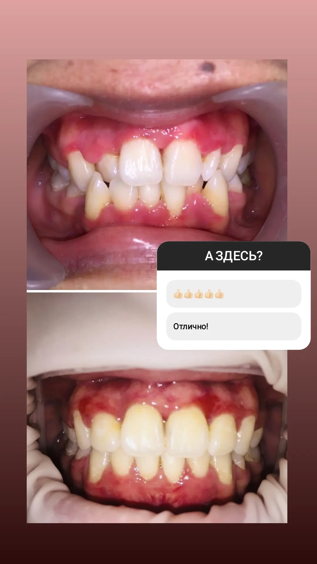 Профессиональная чистка зубов