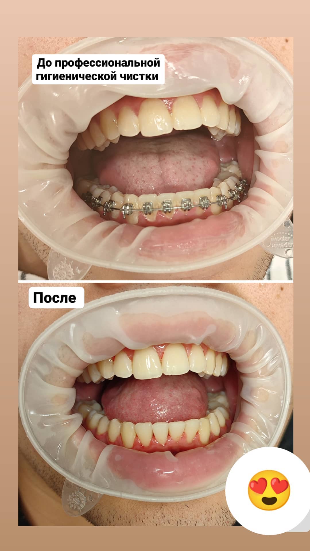 Коронки из диоксида циркония