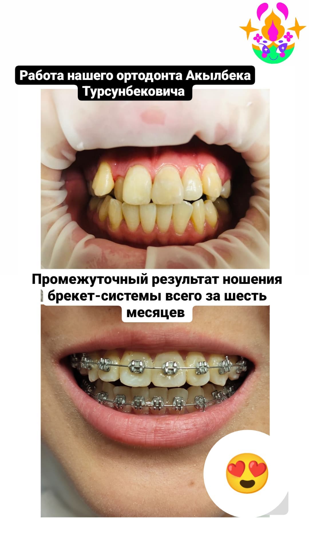 Ортодонтия и брекеты