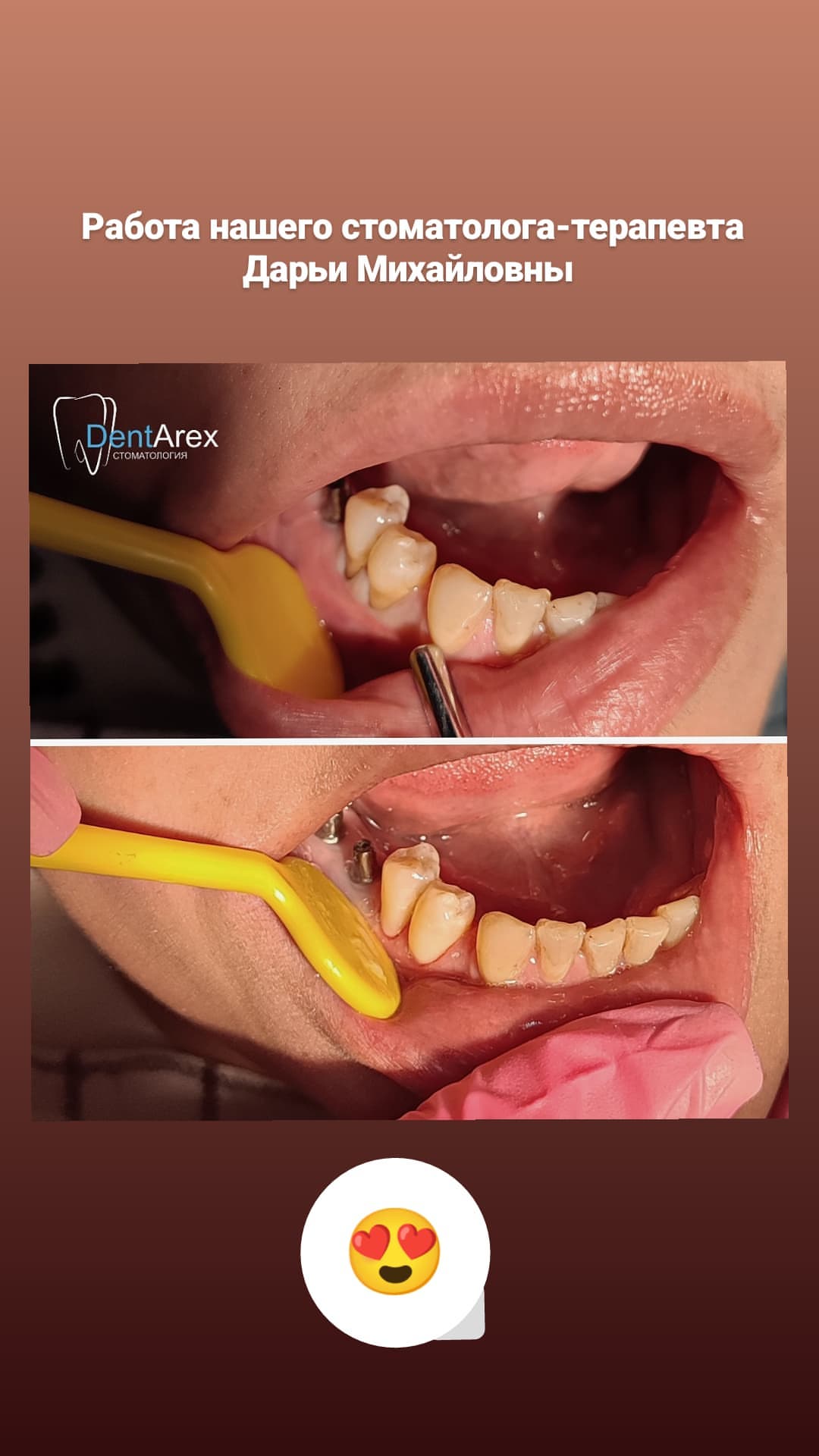 Имплантация зубов