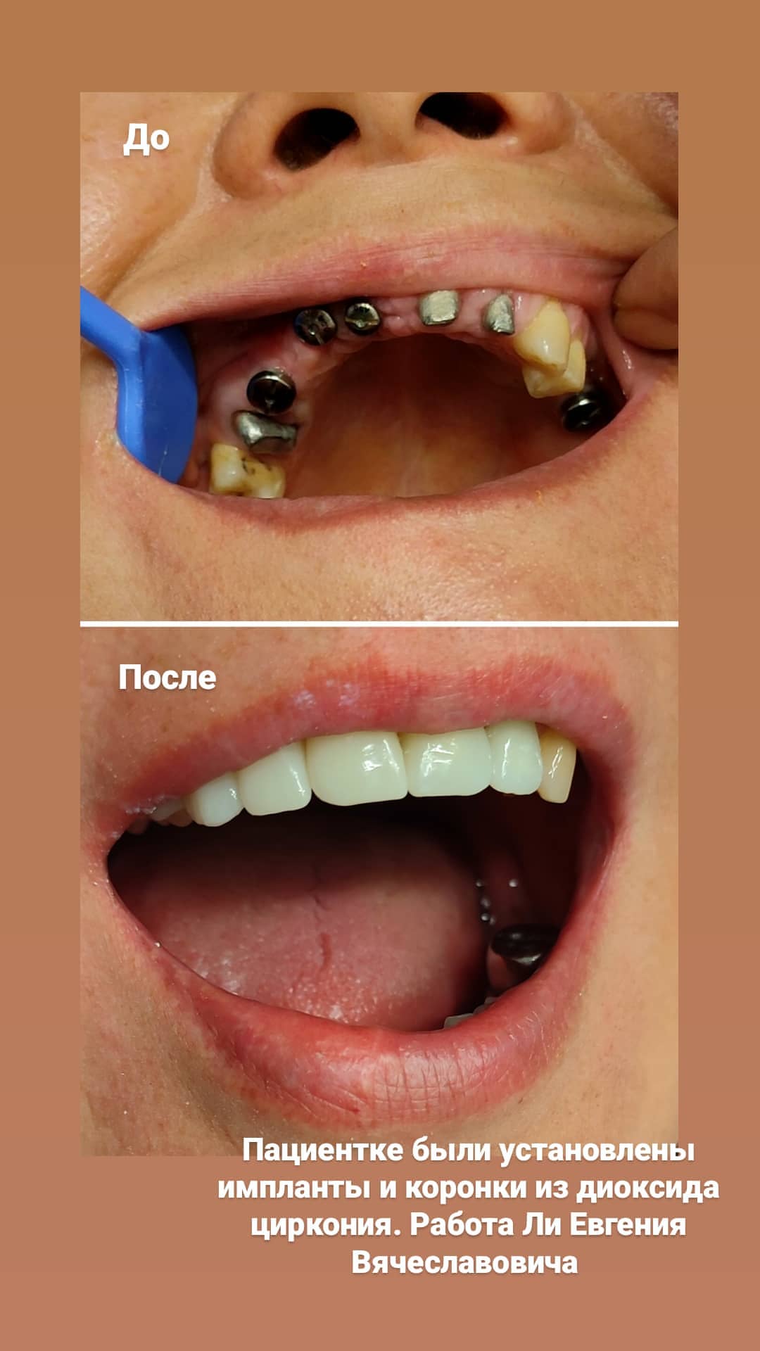 Лечение дёсен