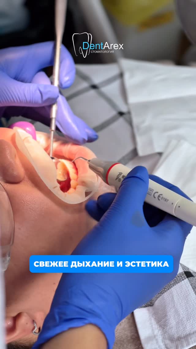 Профессиональная чистка зубов